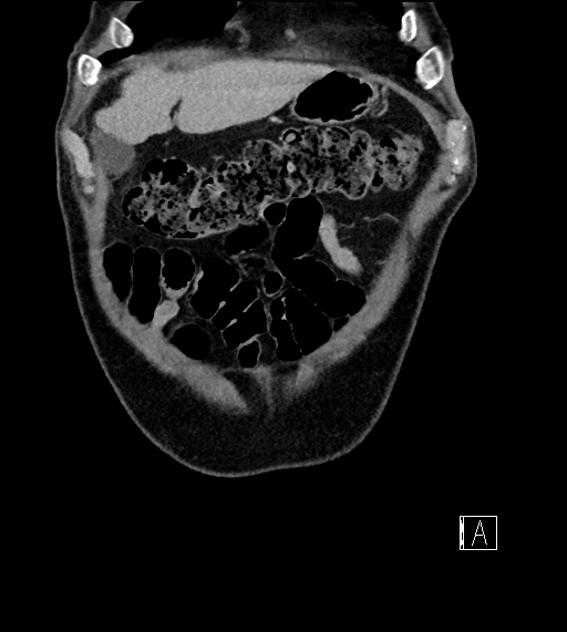 Adrenal lymphoma (Radiopaedia 73730-84529 Coronal C+ portal venous phase 11).jpg