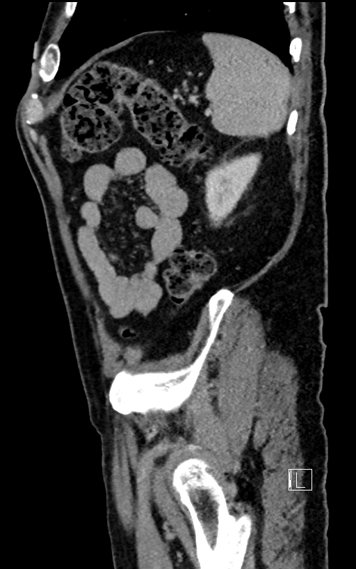 Adrenal lymphoma (Radiopaedia 73730-84529 Sagittal C+ portal venous phase 92).jpg