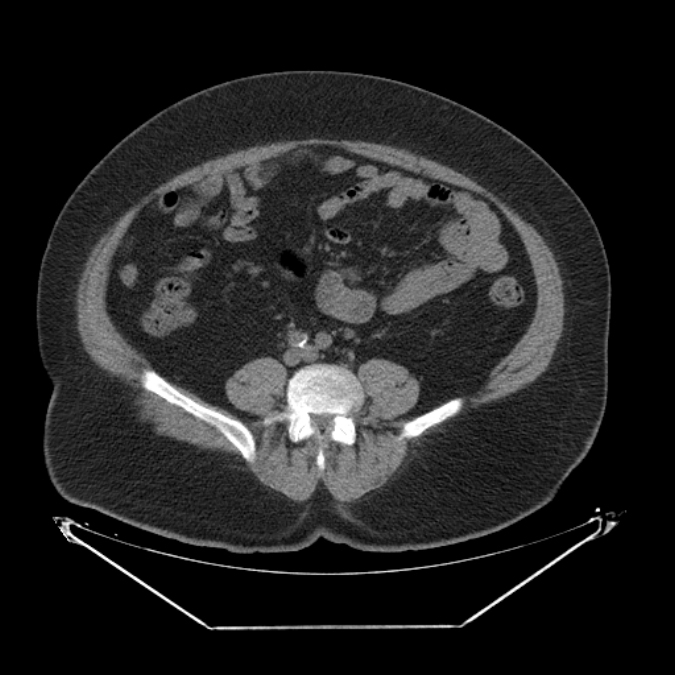 Adrenal myelolipoma (Radiopaedia 26278-26407 Axial non-contrast 45).jpg