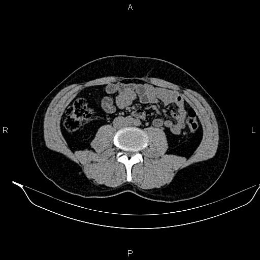 Adrenal myelolipoma (Radiopaedia 87794-104246 Axial non-contrast 60).jpg