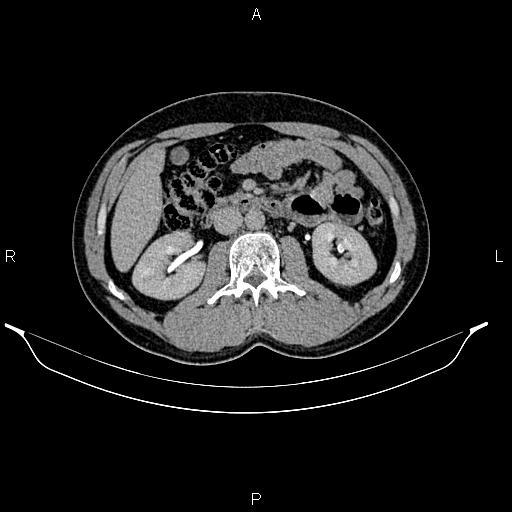 Adrenal myelolipoma (Radiopaedia 87794-104246 Axial renal excretory phase 44).jpg