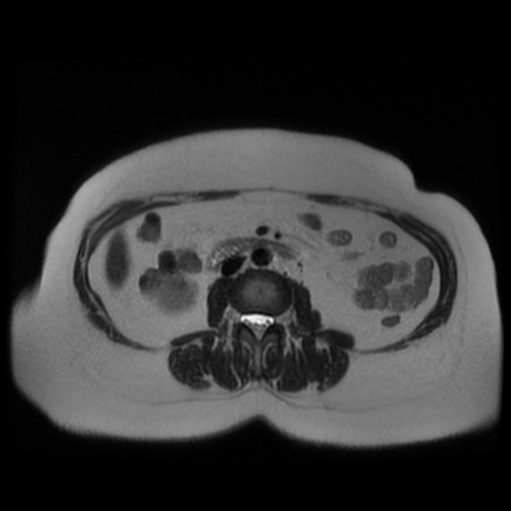 File:Adrenal myelolipoma - MRI (Radiopaedia 83249-97646 Axial T2 26).jpg