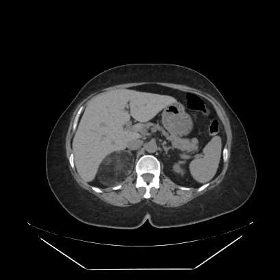 Adrenal myelolipoma - MRI (Radiopaedia 83249-97647 Axial non-contrast 26).jpg