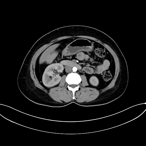 Adrenocortical carcinoma (Radiopaedia 87281-103569 Axial C+ arterial phase 42).jpg