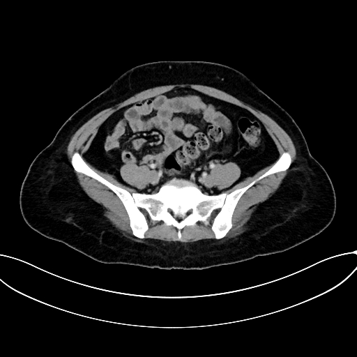 Adrenocortical carcinoma (Radiopaedia 87281-103569 Axial C+ portal venous phase 63).jpg