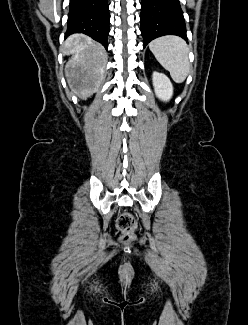 Adrenocortical carcinoma (Radiopaedia 87281-103569 Coronal C+ portal venous phase 124).jpg