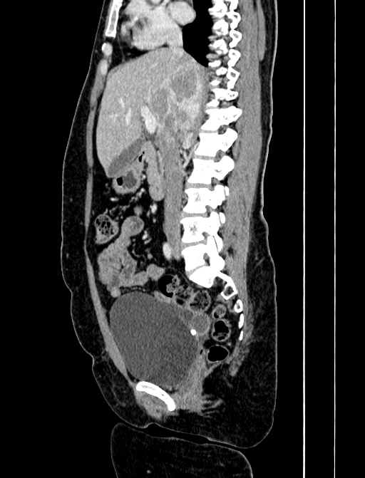 Adrenocortical carcinoma (Radiopaedia 87281-103569 Sagittal C+ portal venous phase 129).jpg