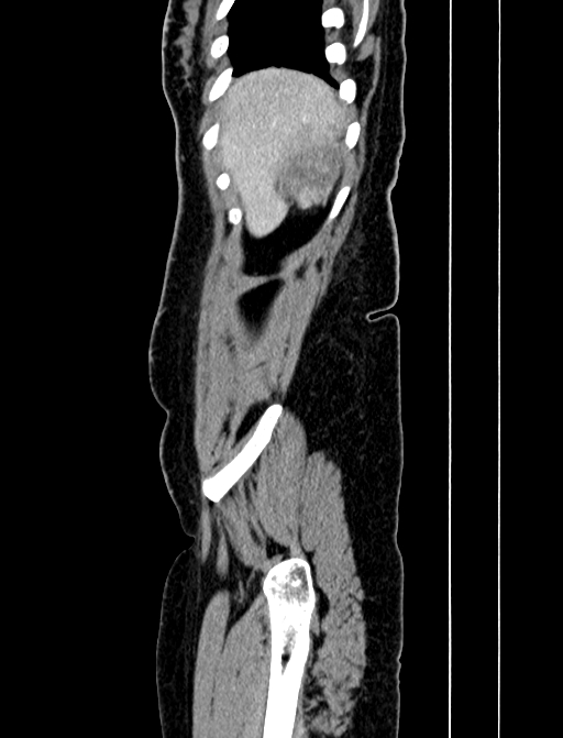 Adrenocortical carcinoma (Radiopaedia 87281-103569 Sagittal C+ portal venous phase 13).jpg