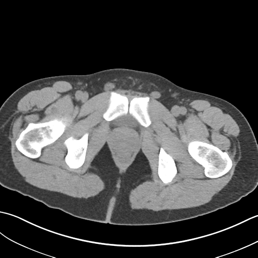 File:Adult polycystic kidney disease (Radiopaedia 47866-52626 Axial non-contrast 87).png