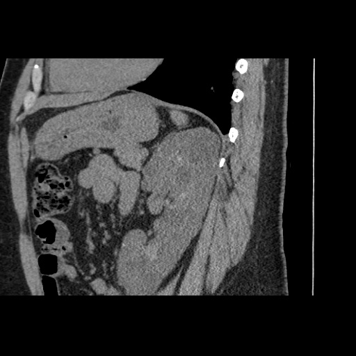 Adult polycystic kidney disease (Radiopaedia 59075-66368 Sagittal non-contrast 61).jpg