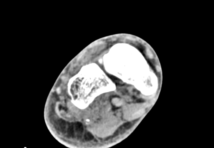Advanced osteomyelitis due to open metatarsal fracture (Radiopaedia 83891-99095 Axial non-contrast 19).jpg