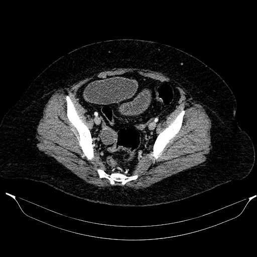 Afferent loop syndrome - secondary to incarcerated trocar site hernia (Radiopaedia 82959-97305 Axial C+ portal venous phase 197).jpg