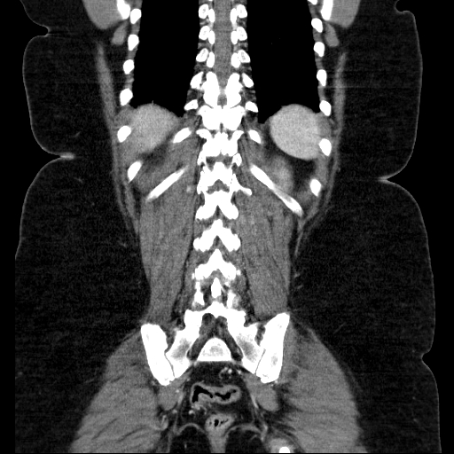 File:Afferent loop syndrome - secondary to incarcerated trocar site hernia (Radiopaedia 82959-97305 Coronal C+ portal venous phase 116).jpg
