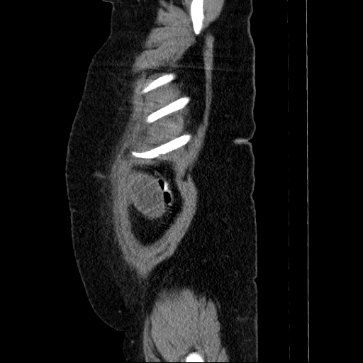 Afferent loop syndrome - secondary to incarcerated trocar site hernia (Radiopaedia 82959-97305 Sagittal C+ portal venous phase 9).jpg