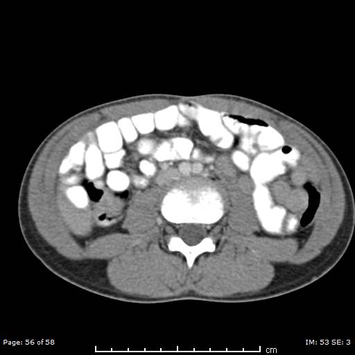 Agenesis of the gallbladder (Radiopaedia 55454-61905 B 56).jpg