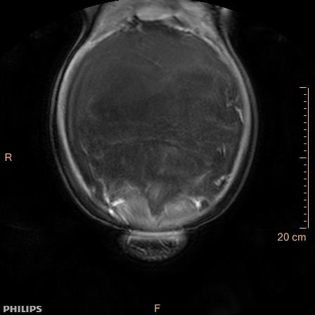 Aggressive angiomyxoma (Radiopaedia 73343-84093 G 18).jpg
