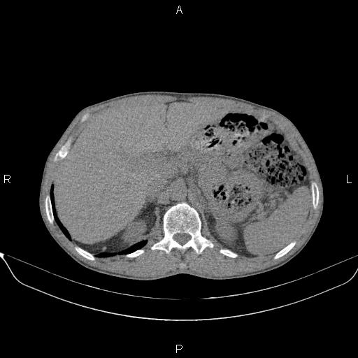 Air bronchogram in pneumonia (Radiopaedia 85719-101512 Axial non-contrast 70).jpg