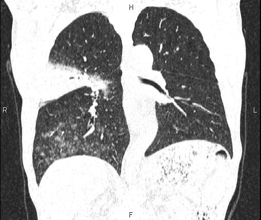 Air bronchogram in pneumonia (Radiopaedia 85719-101512 Coronal lung window 36).jpg