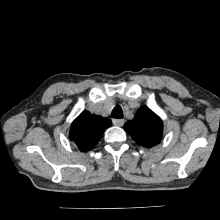 Airway foreign body in adult (Radiopaedia 85907-101779 Axial liver window 1).jpg