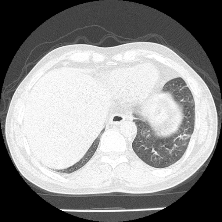 Airway foreign body in adult (Radiopaedia 85907-101779 Axial lung window 157).jpg