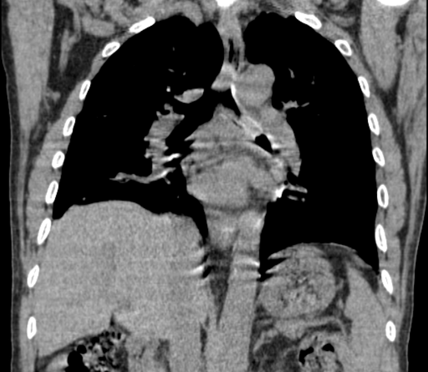 Airway foreign body in adult (Radiopaedia 85907-101779 Coronal liver window 155).jpg
