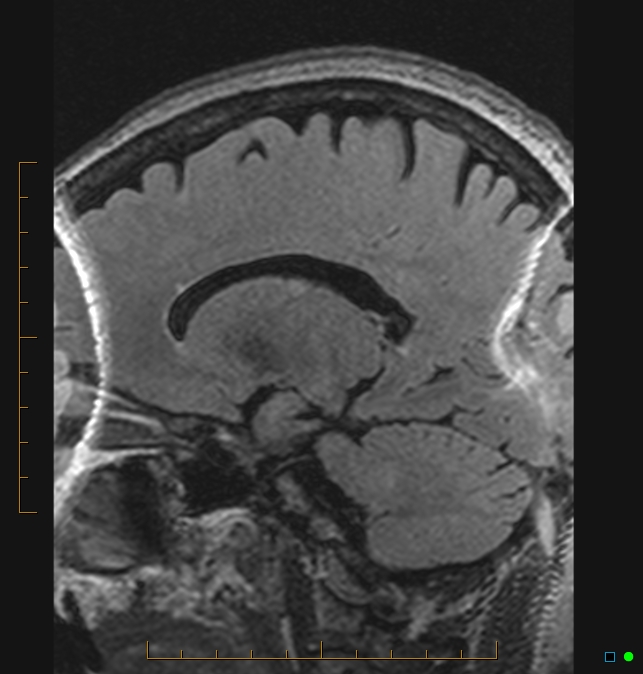 Aliasing artifact causing a spurious cerebellar lesion (Radiopaedia 48783-53810 Sagittal FLAIR 20).jpg