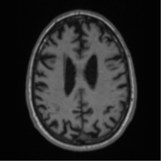 Alzheimer's disease- with Gerstmann syndrome and dressing apraxia (Radiopaedia 54882-61150 Axial T1 51).png