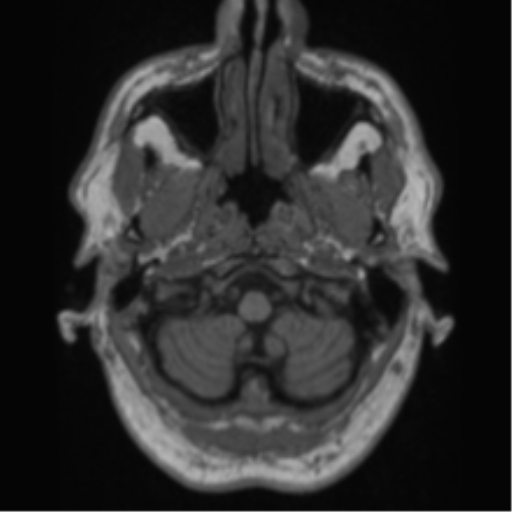 Alzheimer's disease- with Gerstmann syndrome and dressing apraxia (Radiopaedia 54882-61150 Axial T1 6).png