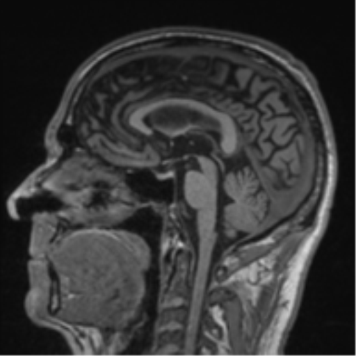 Alzheimer's disease- with Gerstmann syndrome and dressing apraxia (Radiopaedia 54882-61150 Sagittal T1 36).png