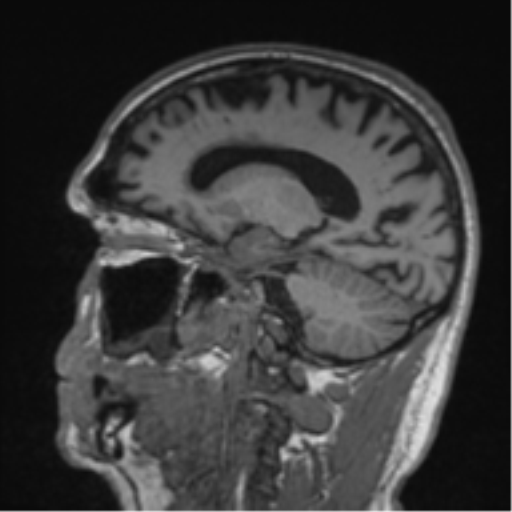 Alzheimer's disease- with Gerstmann syndrome and dressing apraxia (Radiopaedia 54882-61150 Sagittal T1 45).png