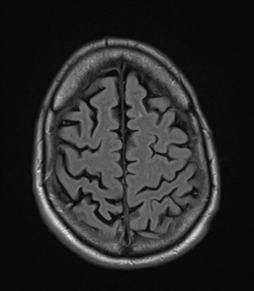 File:Alzheimer's disease- with apraxia (Radiopaedia 54763-61011 Axial FLAIR 23).png