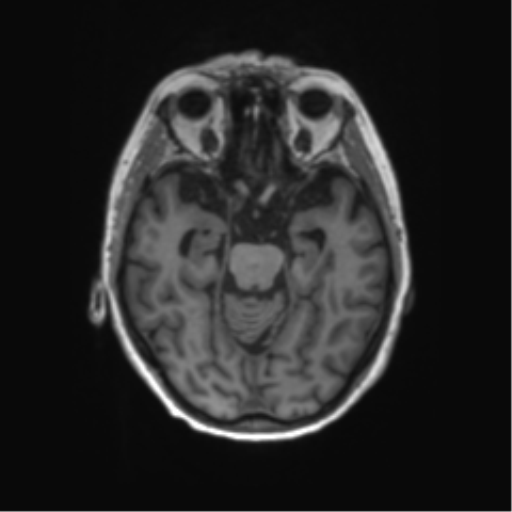 File:Alzheimer's disease (Radiopaedia 42658-45802 Axial T1 98).png