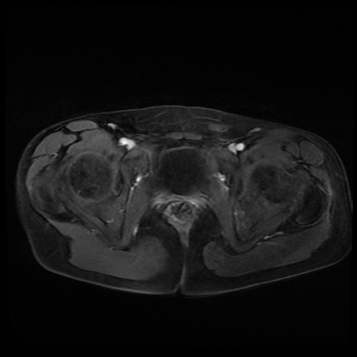 Ambiguous genitalia (Radiopaedia 69686-79643 Axial T1 C+ fat sat 39).jpg