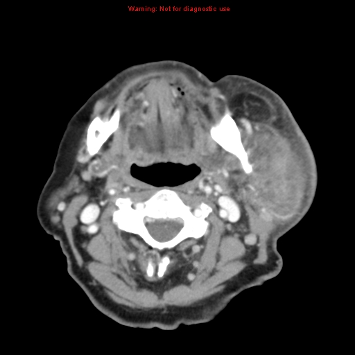 Ameloblastoma (Radiopaedia 27437-27631 A 45).jpg