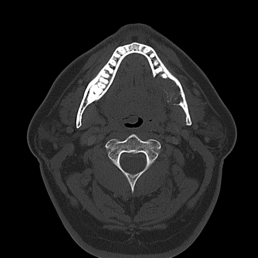 Ameloblastoma (Radiopaedia 38520-40623 Axial bone window 31).png