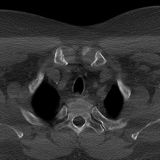 Ameloblastoma (Radiopaedia 38520-40623 Axial bone window 76).png