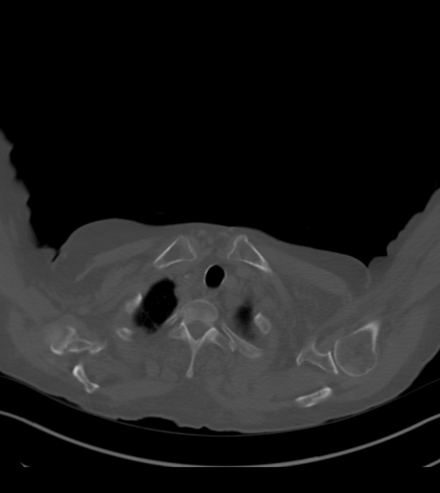 Amiodarone deposition in the liver (Radiopaedia 77587-89780 Axial bone window 8).jpg