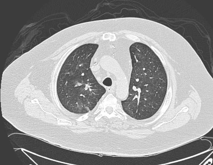 File:Amiodarone lung (Radiopaedia 62514-70769 Axial lung window 27).jpg