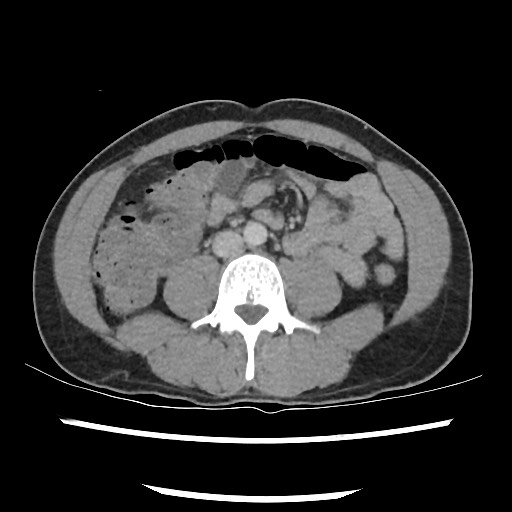 Amoebic liver abscesses (Radiopaedia 55536-62010 A 54).jpg