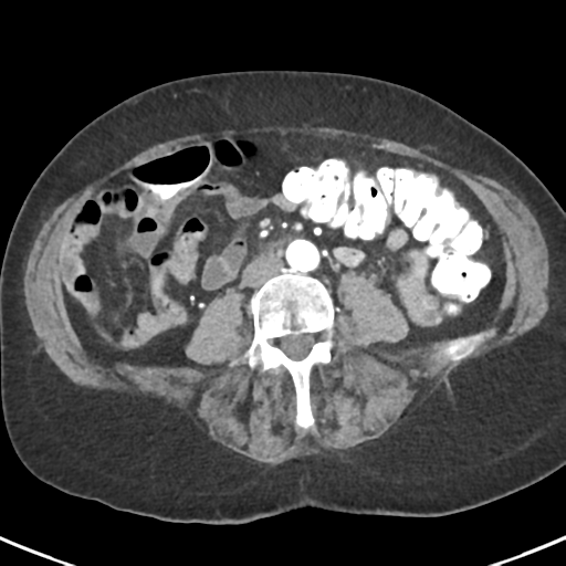 Ampullary adenocarcinoma (Radiopaedia 34013-35237 B 59).png