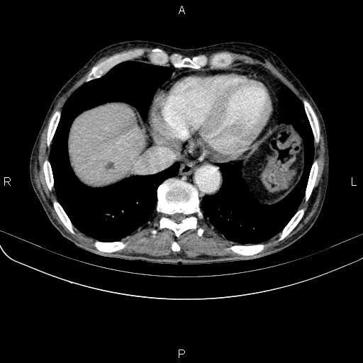 Ampullary adenocarcinoma (Radiopaedia 86093-102033 B 45).jpg