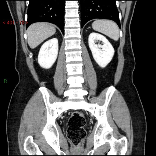Ampullary carcinoma (Radiopaedia 56396-63056 E 69).jpg