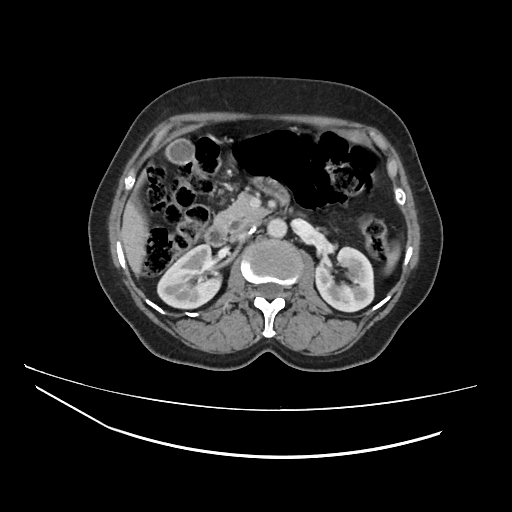 Ampullary tumor (Radiopaedia 60333-67998 A 31).jpg