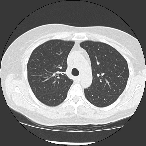 Amyloidosis - bronchial and diffuse nodular pulmonary involvement (Radiopaedia 60156-67744 B 19).jpg