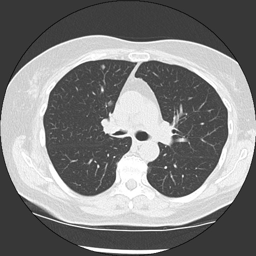 Amyloidosis - bronchial and diffuse nodular pulmonary involvement (Radiopaedia 60156-67744 B 24).jpg