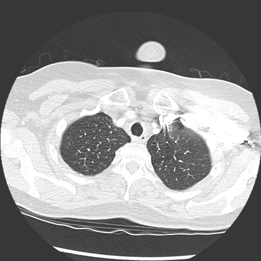 Amyloidosis - bronchial and diffuse nodular pulmonary involvement (Radiopaedia 60156-67745 Axial lung window 9).jpg