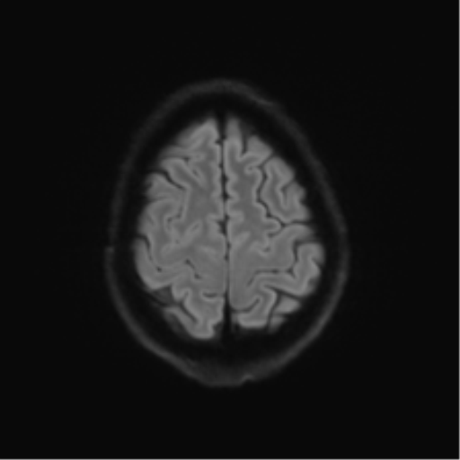 Anaplastic astrocytoma IDH mutant (Radiopaedia 50046-55341 Axial DWI 51).png