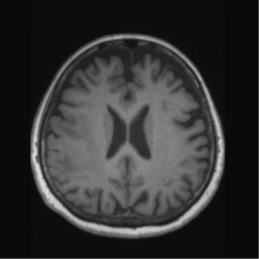 Anaplastic astrocytoma IDH wild-type (pseudoprogression) (Radiopaedia 42209-45276 Axial T1 97).png