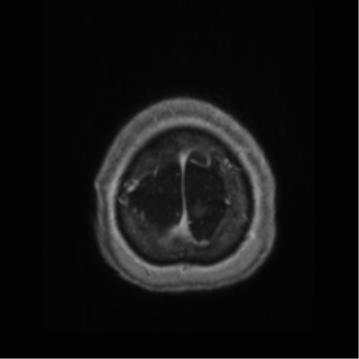 Anaplastic astrocytoma IDH wild-type (pseudoprogression) (Radiopaedia 42209-45277 Axial T1 C+ 123).png