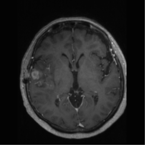 File:Anaplastic astrocytoma IDH wild-type (pseudoprogression) (Radiopaedia 42209-45277 Axial T1 C+ 61).png